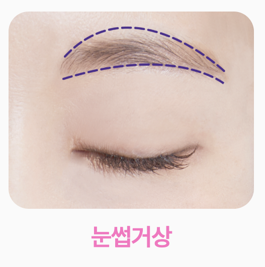 눈썹거상 중년눈수술 눈밑지방재배치