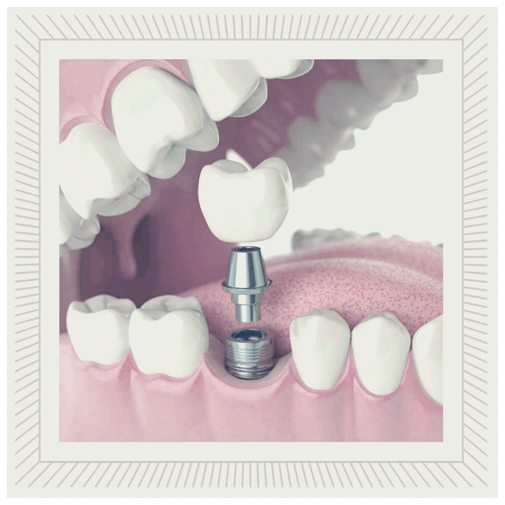 치과 임플란트 건강보험적용가격