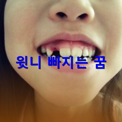 윗니가-방금-빠졌는지-아직도-피가-나고있는-모습