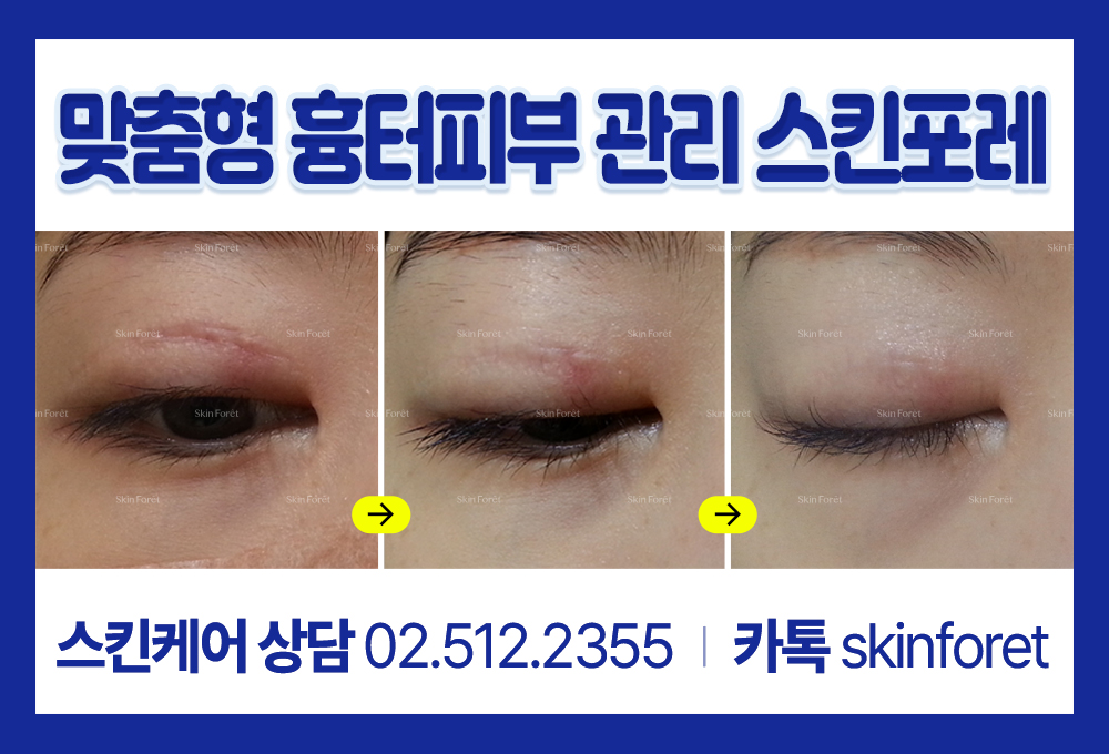 쌍꺼풀흉터로 인한 눈덜감김 개선 관리 사례