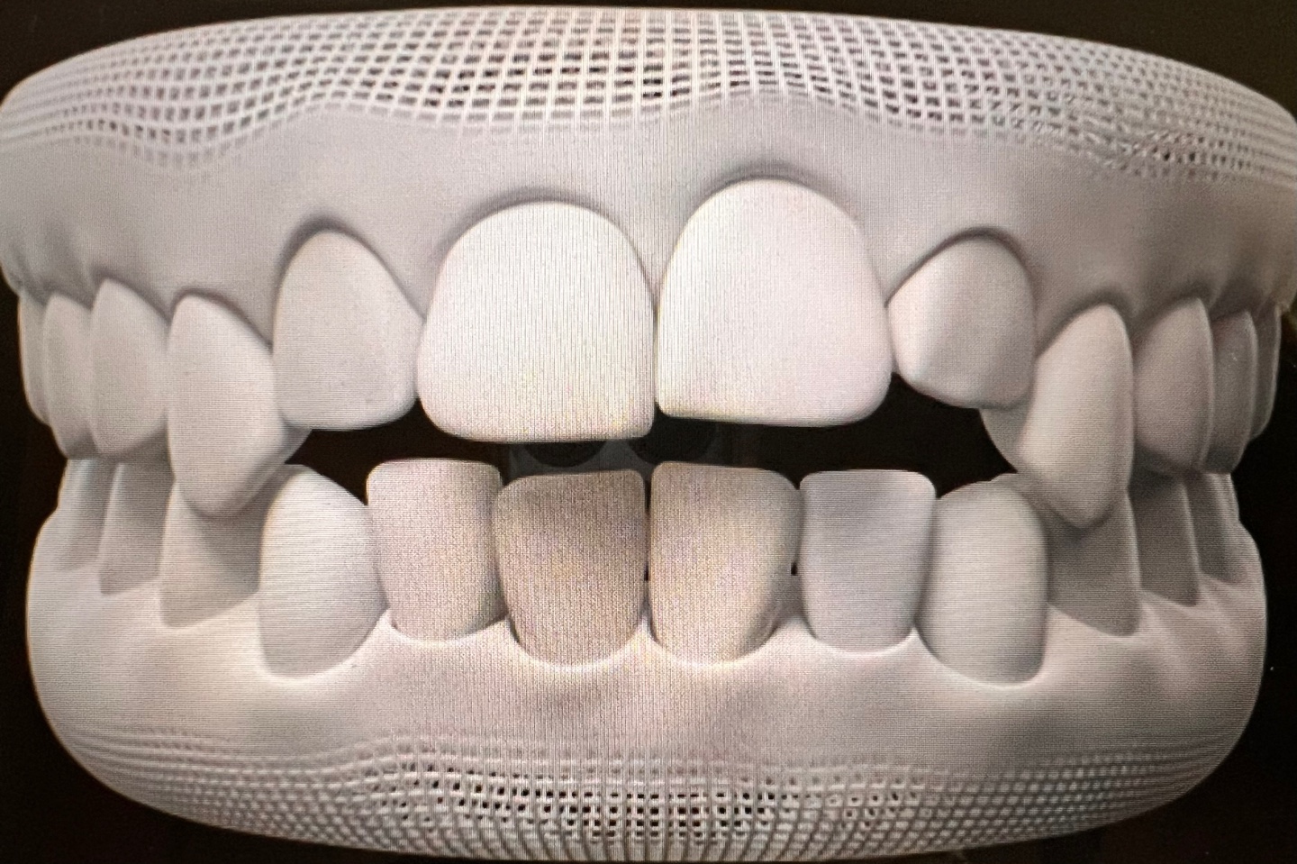 인비절라인 케이스&#44; 개방교합&#44;윗니와 아랫니 사이에 공간이 보인다