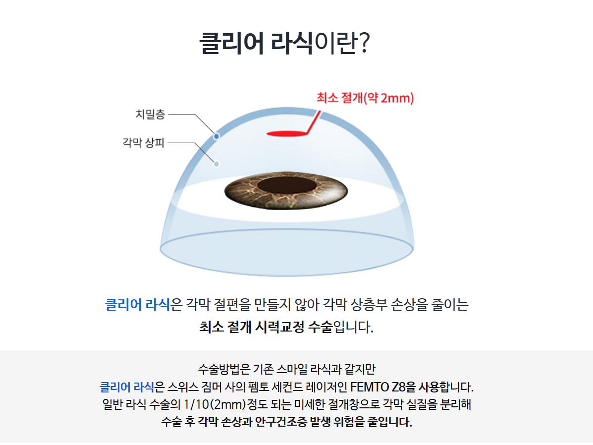 강남큐브안과-클리어라식-비용-할인