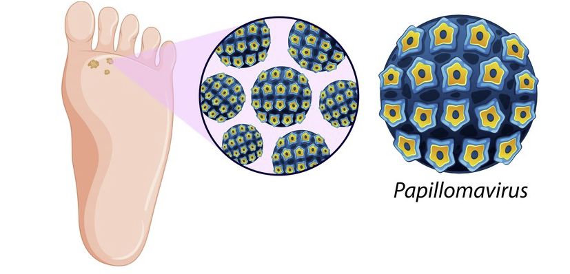 사람유두종_바이러스_사진