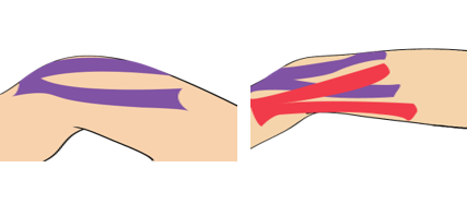 무릎 통증(내측)