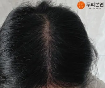 정수리가 아픈 이유와 완화하는 방법_4