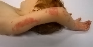 팔-대상포진