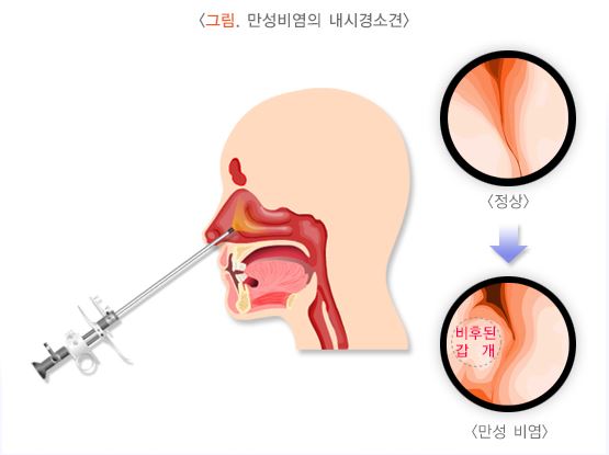 만성비염을-내시경하는-그림