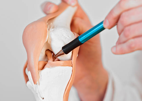 퇴행성 반월상 연골 파열