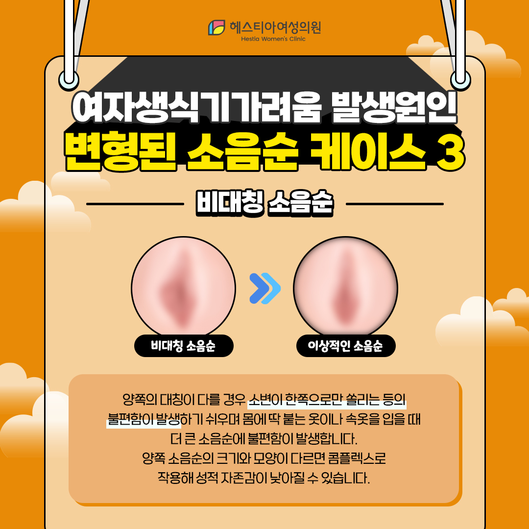 비대칭 소음순
