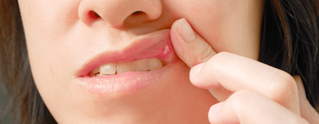 연고가 필요한 구내염 예시