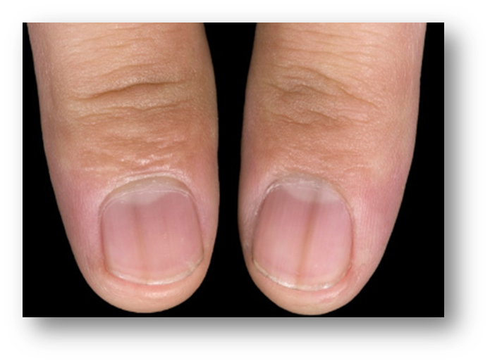 손톱 검은 세로줄3