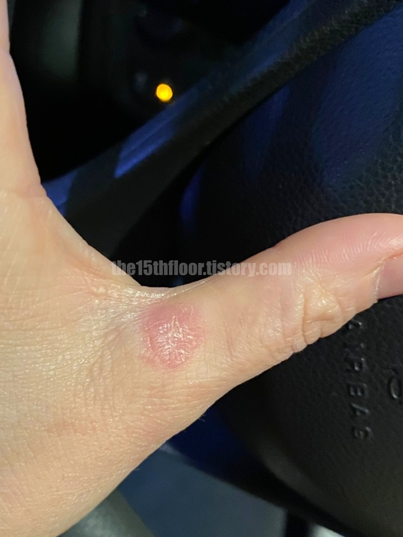 치료 종료 및 상처 관리