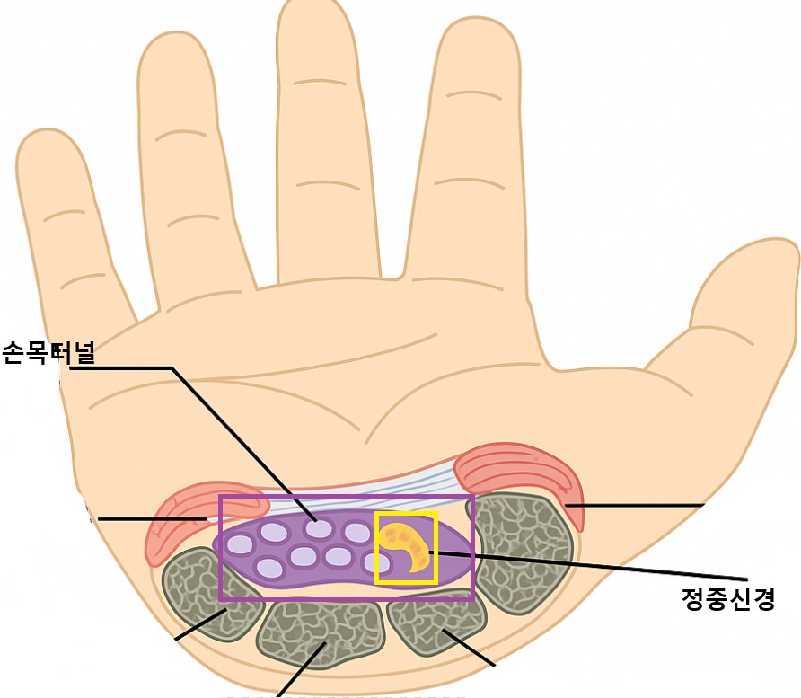 손목터널증후군-위치1