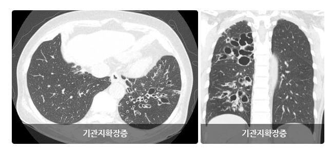 기관지확장증치료