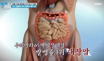 대장암