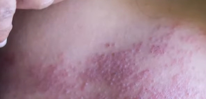 아시클로버 연고 효능