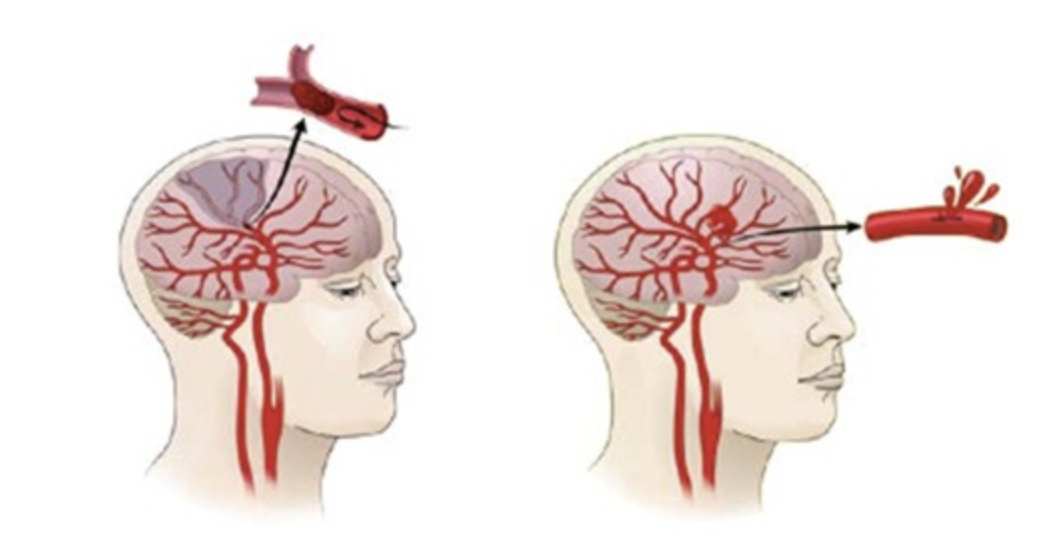뇌경색과 뇌출혈 일러스트