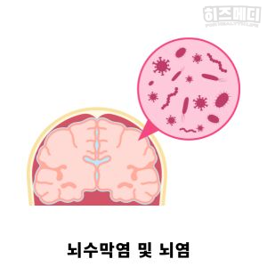 수족구 증상