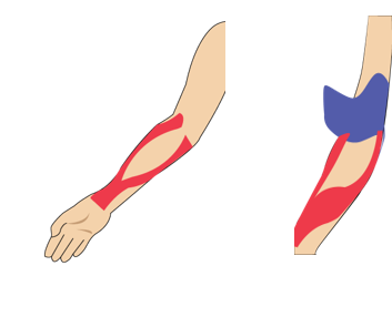 팔꿈치 내측 통증 (내측 상과염 등)