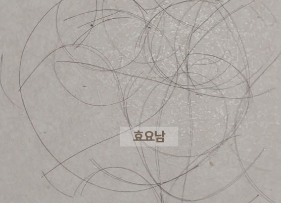 M자 모발이식-암흑기