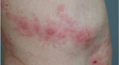 대상포진이미지