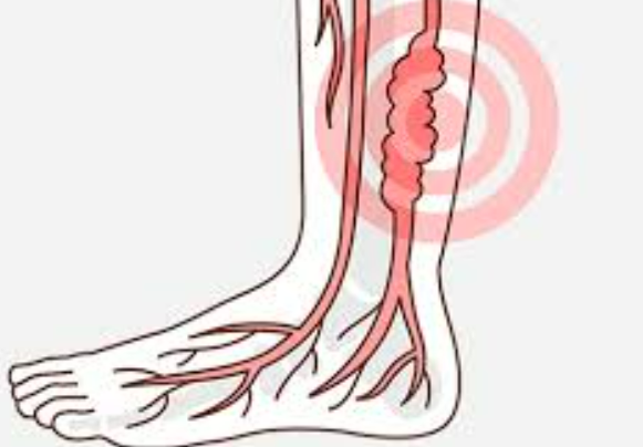 하지정맥류 수술비용과 치료 증상 잘하는 병원 추천