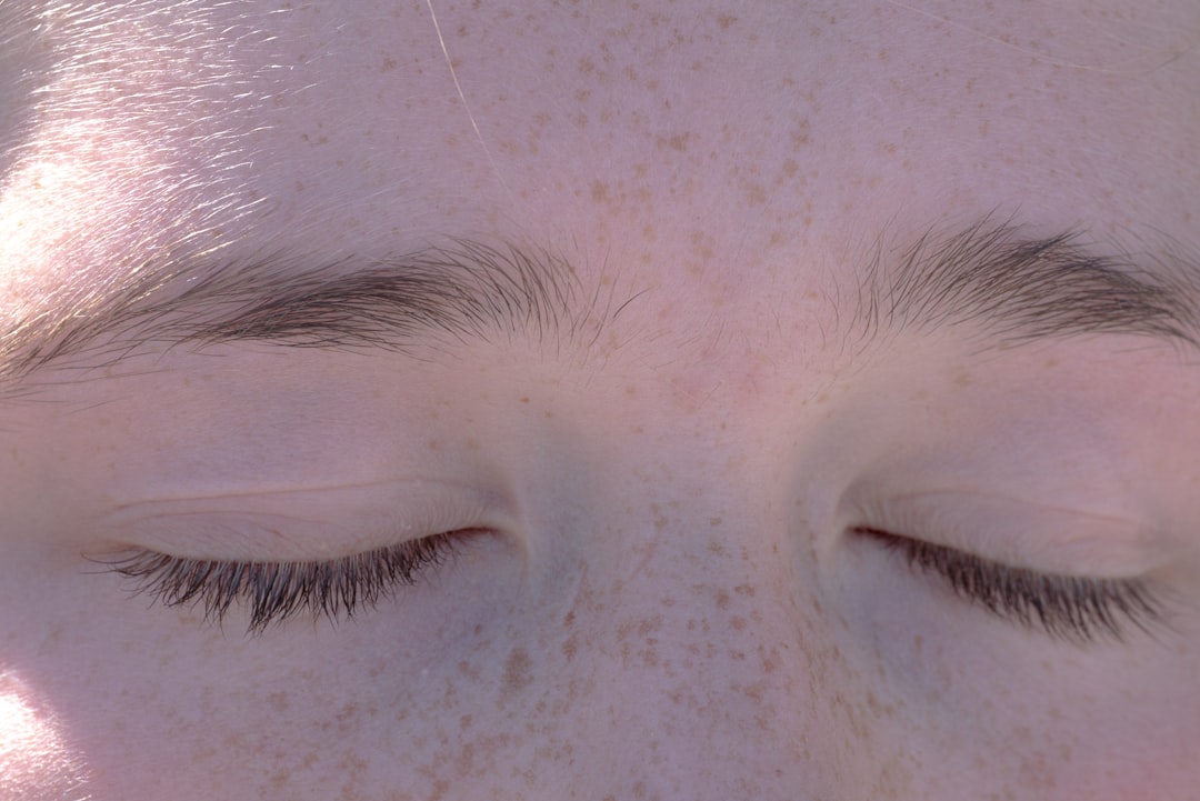 Hyperpigmentation