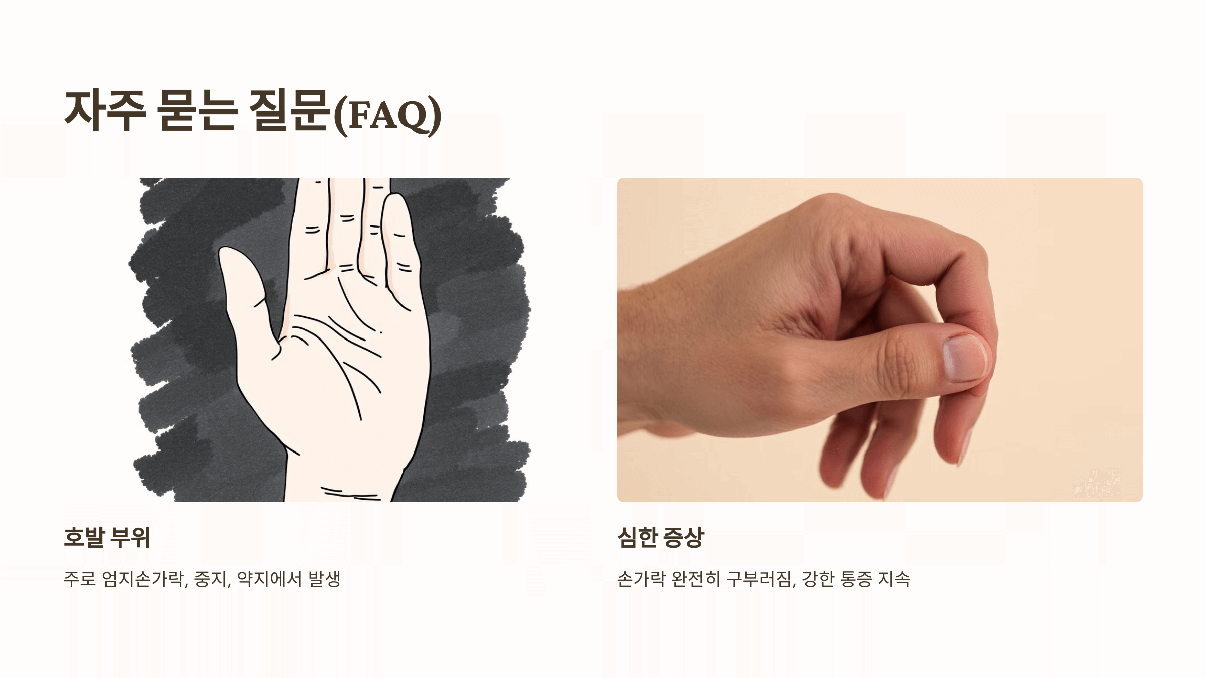 방아쇠 수지 증후군 관련된 사진입니다.