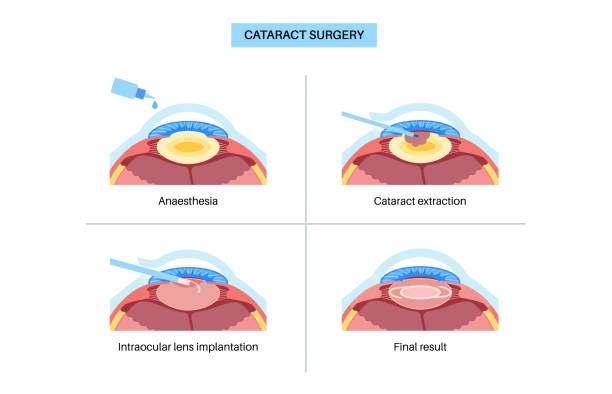 백내장 수술 방법