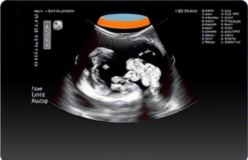 복부초음파 실비보험