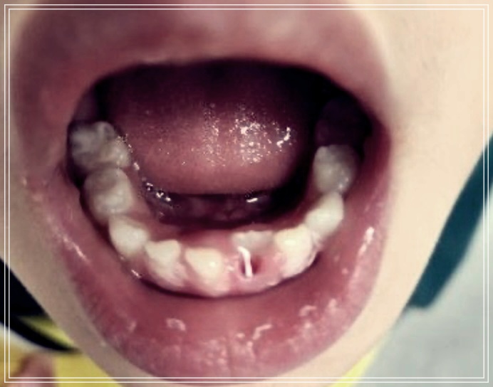 설측 맹출 생기는 이유? 원인 해결방법.