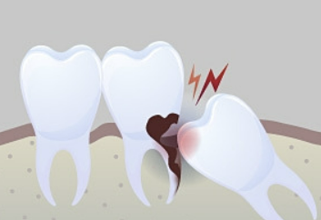 사랑니 발치후 식사 알아보기 커피&amp;#44; 흡연&amp;#44; 음주 정보