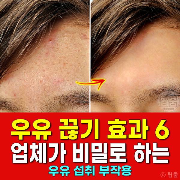 우유 끊으면 우유끊기 여드름