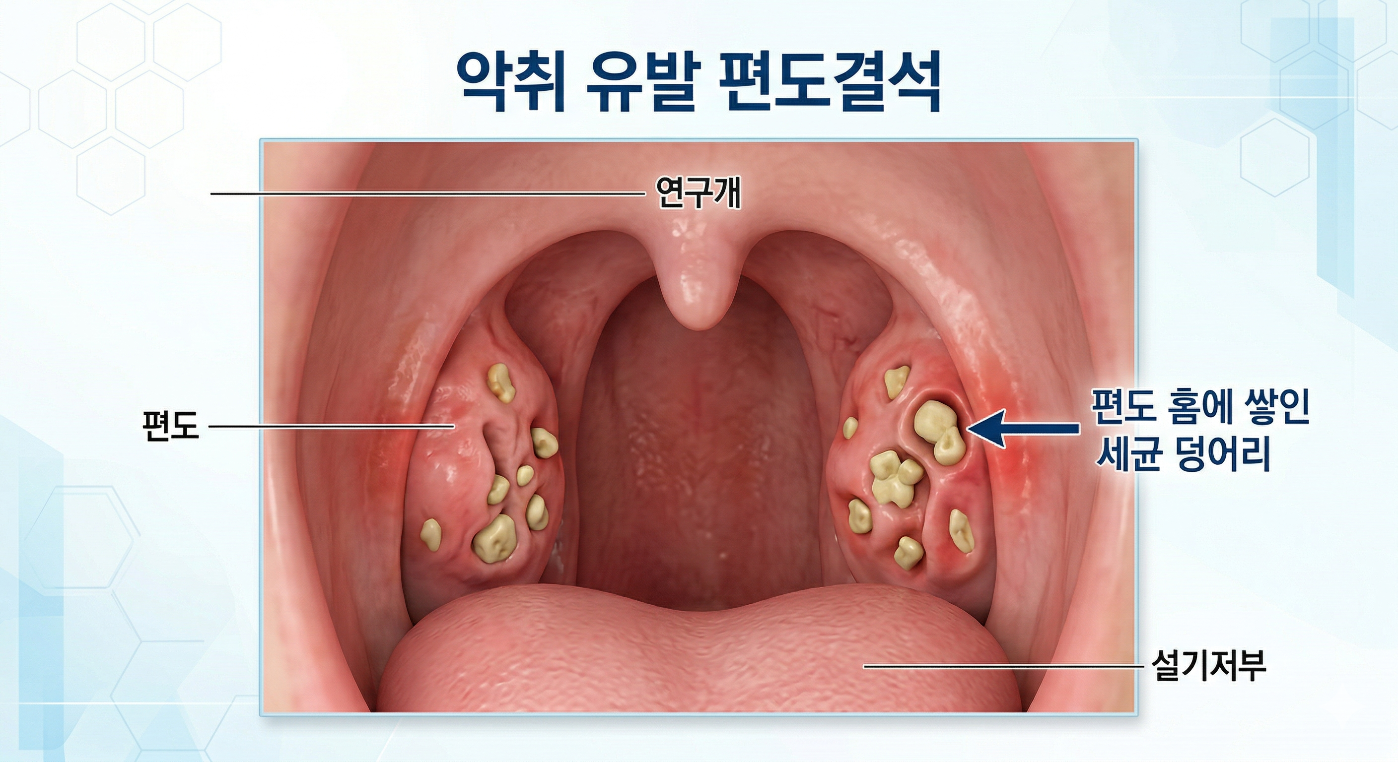 편도결석 원인, 목 이물감, 구취 입냄새 - 목젖 양옆에 부어오른 편도의 깊은 구멍(편도와) 속에 노랗고 냄새나는 세균 덩어리(편도결석)가 꽉 차 있는 3D 구강 단면도