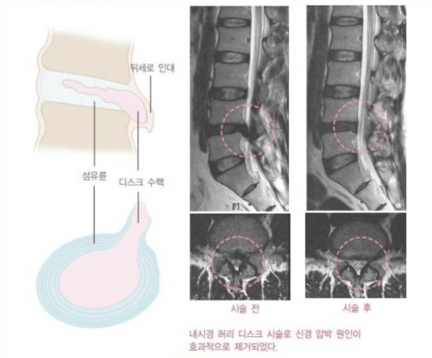 허리디스크 시술