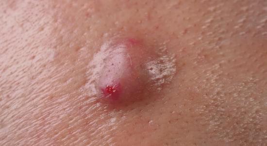 항문농양 – 원인, 증상, 치료법 총정리