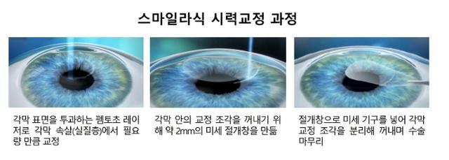 스마일라식-비용-부작용