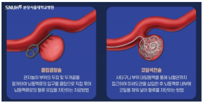 좌 / 클립결찰술, 우 / 코일색전술