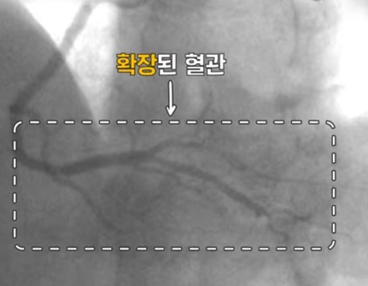 변이형협심증