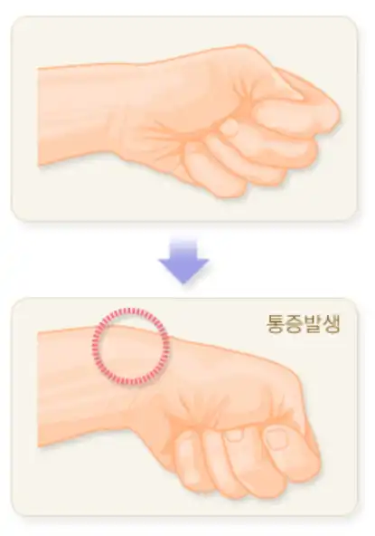 손목건초염-통증발생-이미지