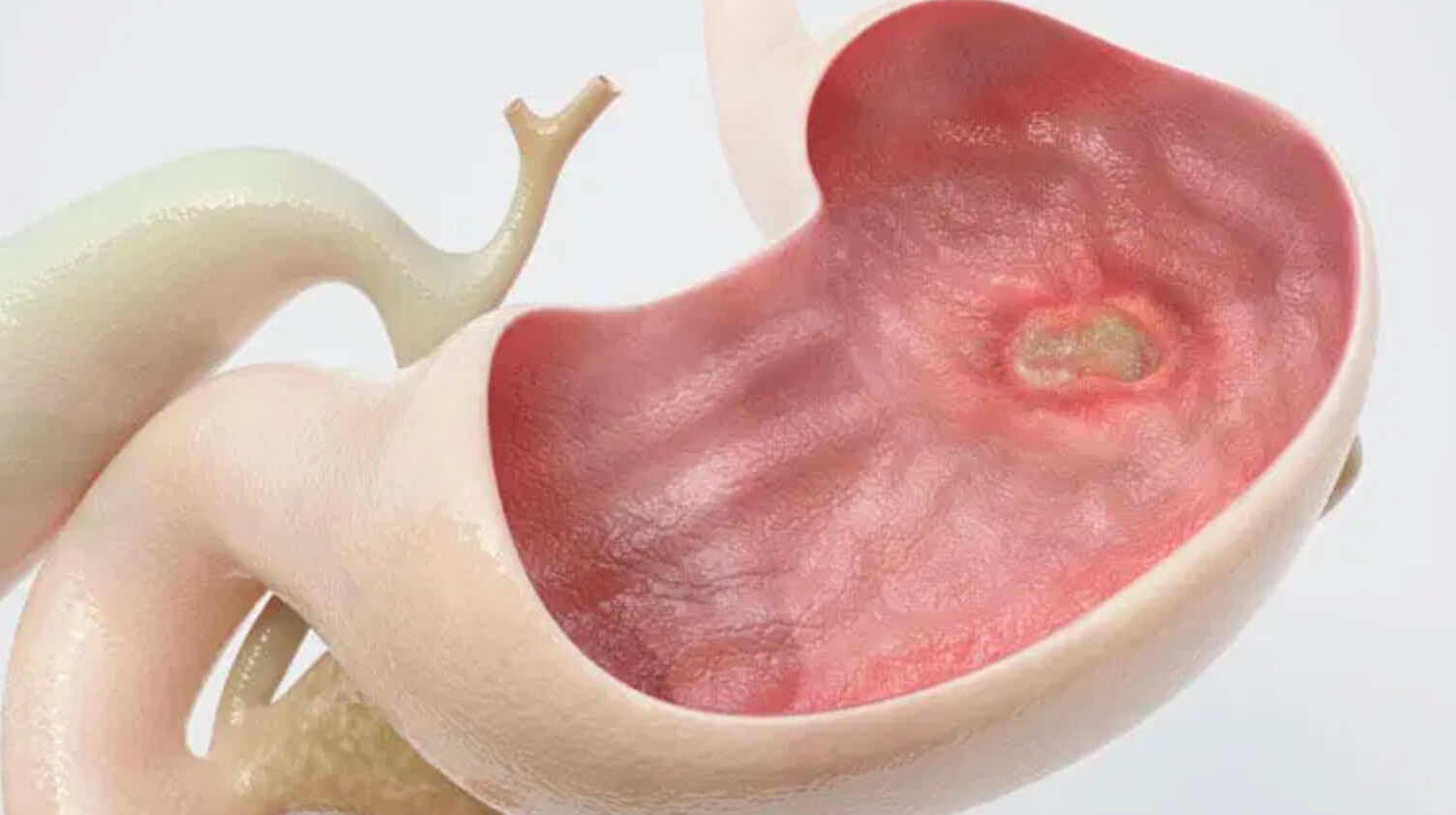 배꼽 주변 통증