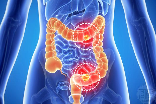 허리둘레 85cm 33인치 대장암,팁줌