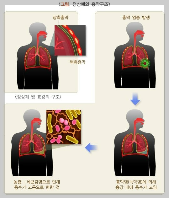 호흡기 질환: 늑막염- 원인, 증상, 진단방법, 치료방법, 후유증.