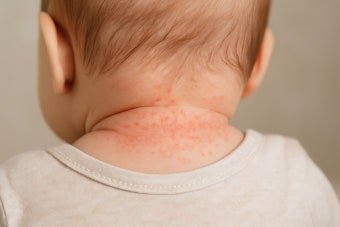 아기 땀띠 관리법 (여름철, 육아, 피부, 필수템)