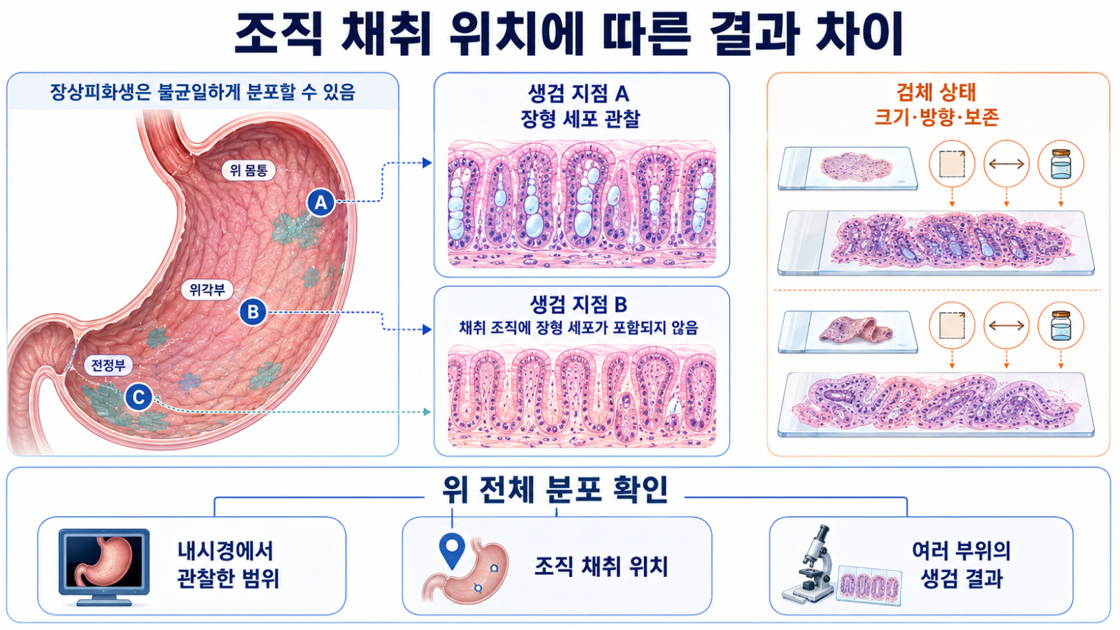 불균일한 장상피화생 분포와 조직 채취 위치·검체 상태에 따른 결과 차이 인포그래픽