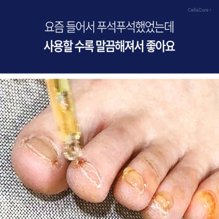 셀라큐어 문제성 발톱 솔루션 내돈내산 후기 부작용 성분 효능 사용법 가격
