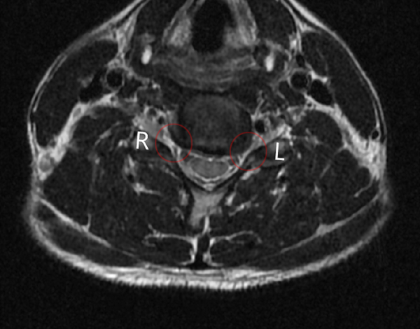 경추-MRI촬영-결과