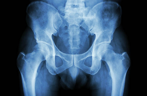 고관절 통증 증상, 통증 원인, 수술 총정리 (2024ver)