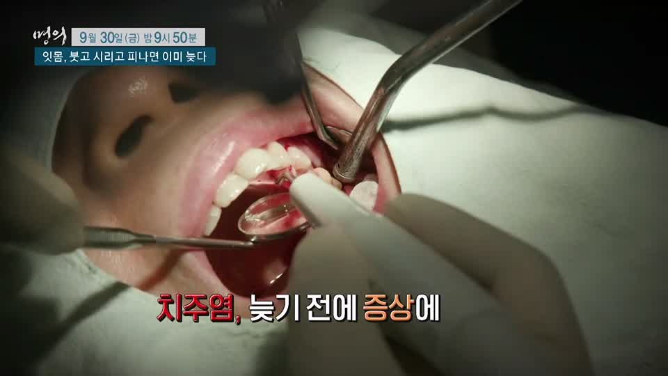 명의 붓고, 시리고, 피나면 이미 늦는 치주염 잇몸 질환 치주질환 치료, 예방 방법