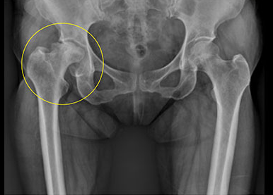 대퇴골두 무혈성 괴사: 조기 발견과 관리의 중요성